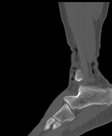 Chopart fracture (Radiopaedia 35347-36851 Sagittal bone window 50).jpg