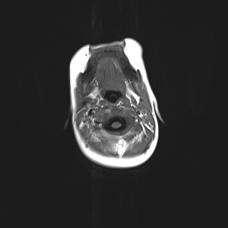 File:Choroid plexus papilloma (Radiopaedia 84612-100019 Axial T1 1).jpg