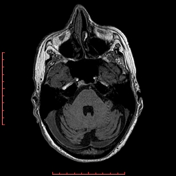 Choroid plexus xanthogranuloma (Radiopaedia 67843-77270 Axial T1 121).jpg