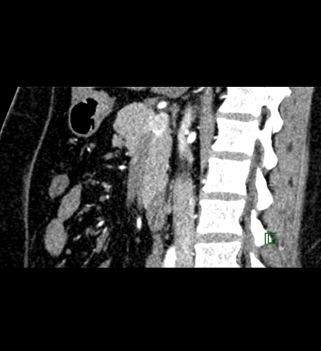 Chromophobe renal cell carcinoma (Radiopaedia 84286-99573 F 89).jpg