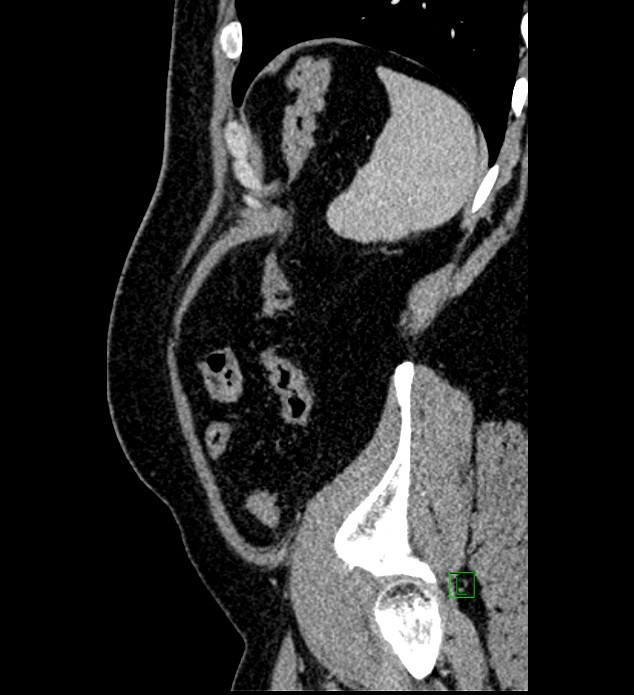 Chromophobe renal cell carcinoma (Radiopaedia 84286-99573 I 25).jpg