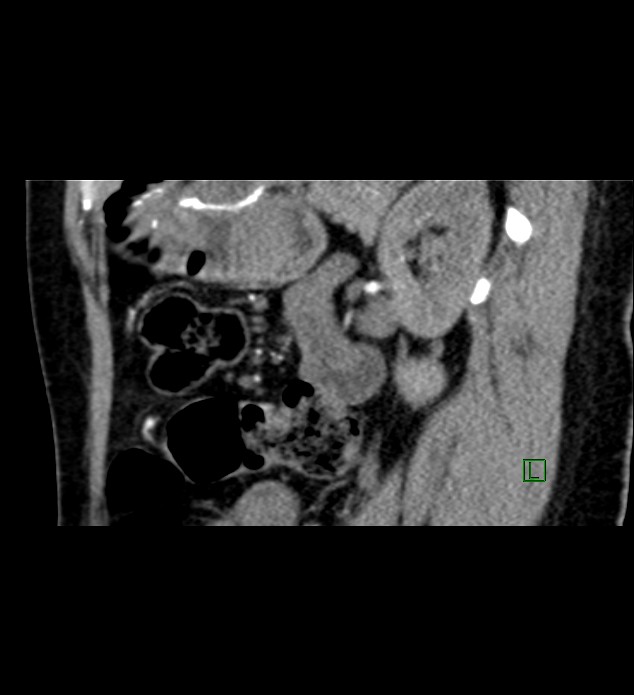 Chromophobe renal cell carcinoma (Radiopaedia 84290-99582 D 34).jpg