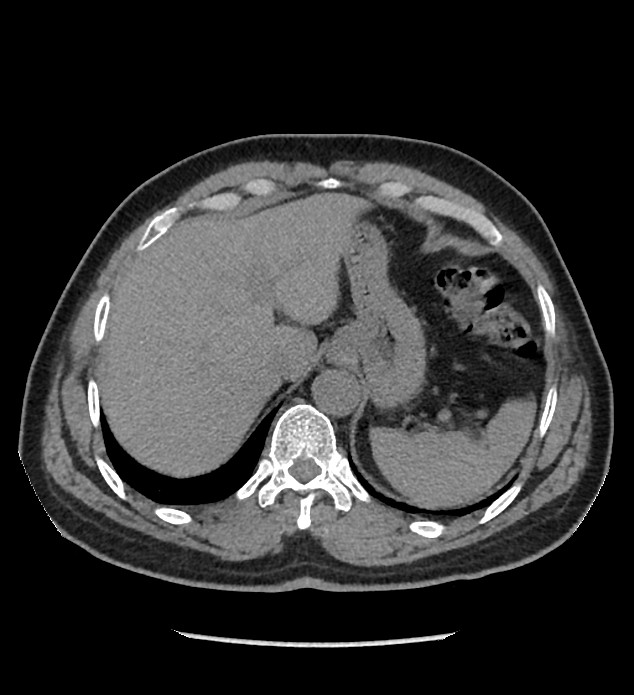 Chromophobe renal cell carcinoma (Radiopaedia 86879-103083 Axial non-contrast 7).jpg