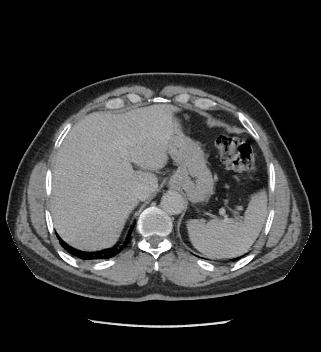 Chromophobe renal cell carcinoma (Radiopaedia 86879-103083 D 22).jpg