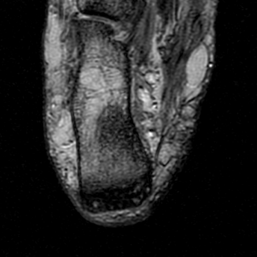 File:Chronic Achilles tendon rupture (Radiopaedia 15262-15100 Axial Gradient Echo 25).jpg