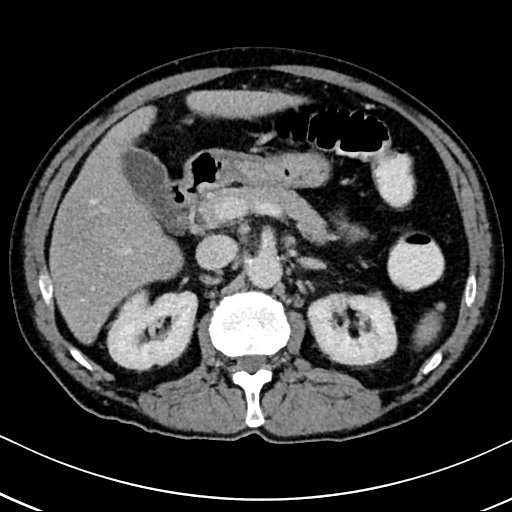 Chronic appendicitis complicated by appendicular abscess, pylephlebitis and liver abscess (Radiopaedia 54483-60700 B 57).jpg