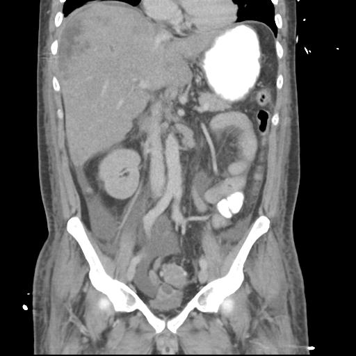 Chronic diverticulitis complicated by hepatic abscess and portal vein thrombosis (Radiopaedia 30301-30938 B 30).jpg