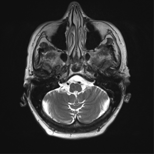 File:Chronic hypertensive encephalopathy (Radiopaedia 39993-42482 Axial T2 7).png