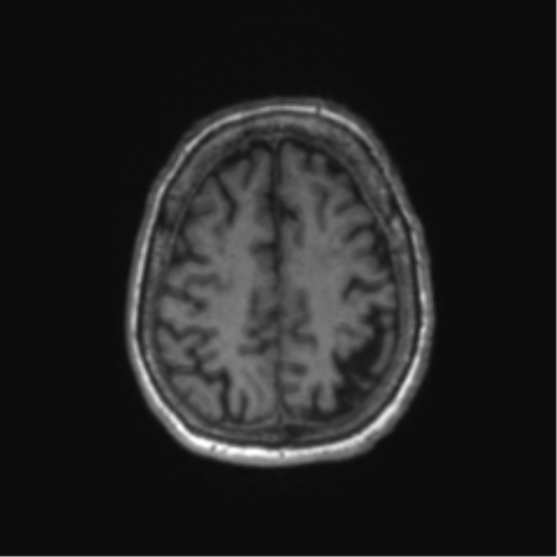 Chronic hypertensive encephalopathy (Radiopaedia 72844-83495 Axial T1 18).png
