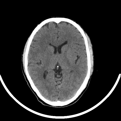 Chronic invasive fungal sinusitis with intraorbital and intracranial extension (Radiopaedia 56387-63046 Axial non-contrast 206).jpg