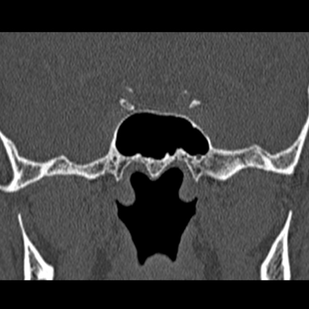 Chronic maxillary sinusitis (Radiopaedia 27879-28116 Coronal bone window 48).jpg