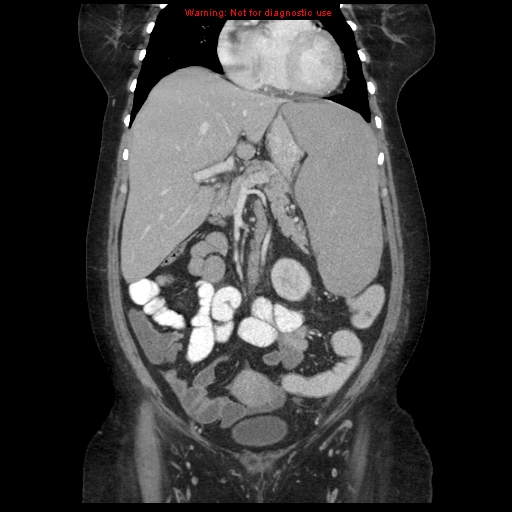 File:Chronic myeloid leukemia with splenic infarction (Radiopaedia 9178-9874 E 21).jpg