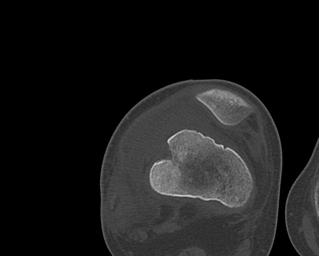 Chronic ostemyelitis of the femur with long sinus tract (Radiopaedia 74947-85982 Axial bone window 205).jpg