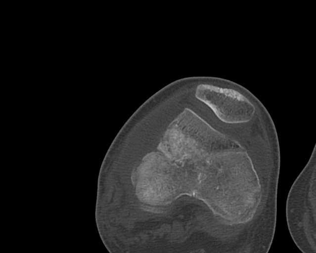File:Chronic ostemyelitis of the femur with long sinus tract (Radiopaedia 74947-85982 Axial bone window 213).jpg