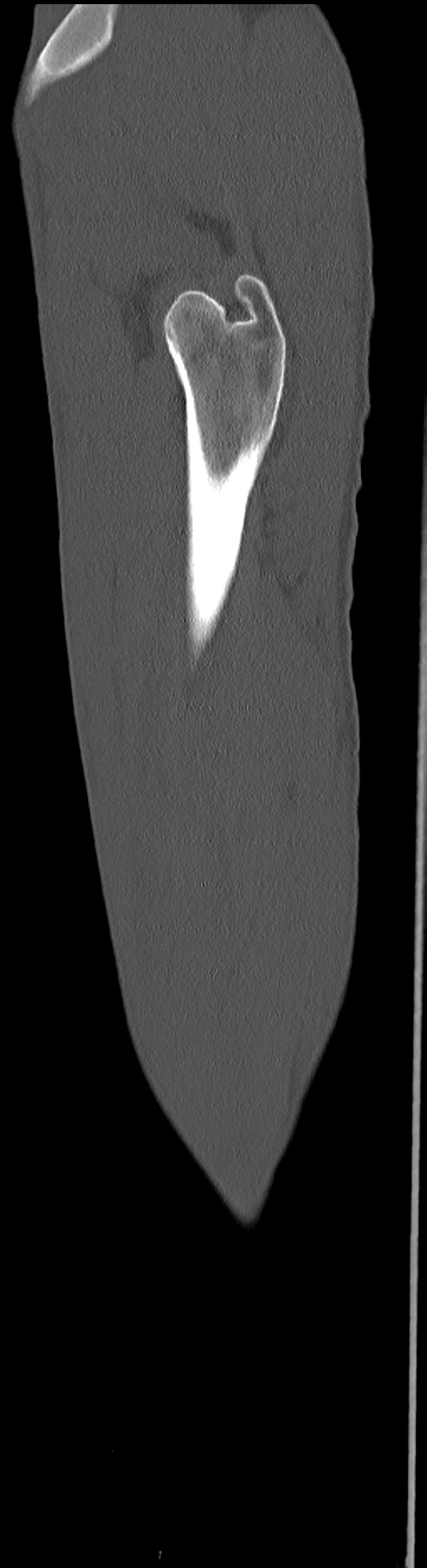 Chronic osteomyelitis (with sequestrum) (Radiopaedia 74813-85822 C 18).jpg