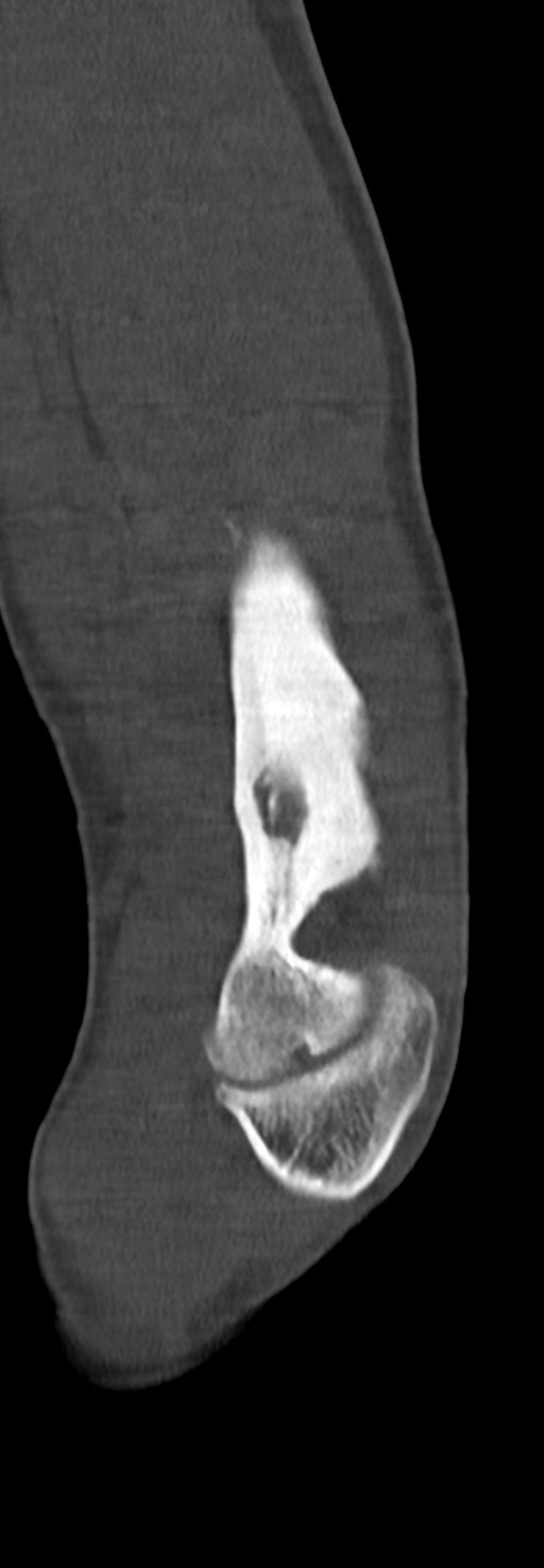 Chronic osteomyelitis of the distal humerus (Radiopaedia 78351-90971 Sagittal bone window 55).jpg