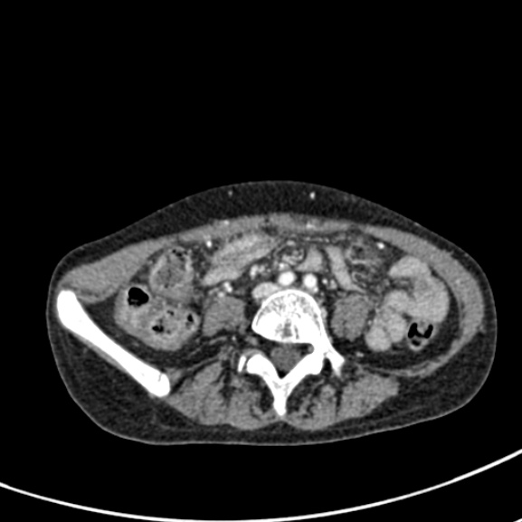 Chronic pancreatitis (Radiopaedia 55405-61846 A 66).jpg