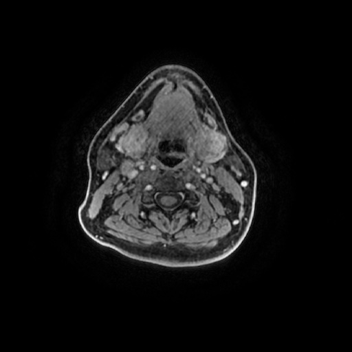 Chronic submandibular sialadenitis (Radiopaedia 61852-69885 Axial T1 C+ fat sat 51).jpg