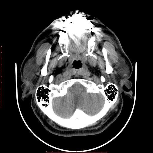 File:Chronic submandibular sialolithiasis (Radiopaedia 69817-79814 Axial non-contrast 39).jpg