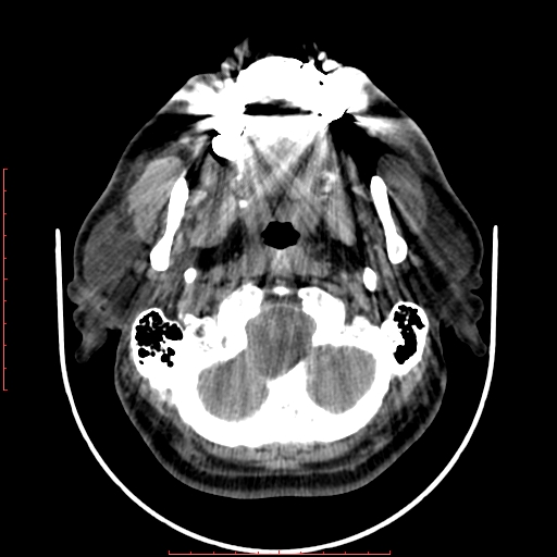 File:Chronic submandibular sialolithiasis (Radiopaedia 69817-79814 Axial non-contrast 45).jpg