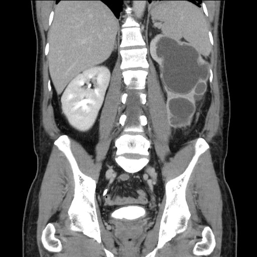 Chronic ureteropelvic junction obstruction (Radiopaedia 78365-90996 B 66).jpg