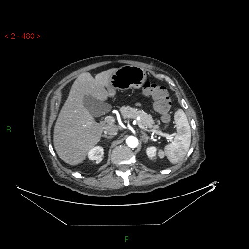 Circumaortic left renal vein and doubled left renal arteries (Radiopaedia 52268-58158 A 16).jpg