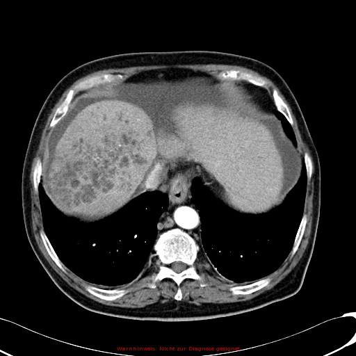 File:Cirrhosis and hepatocellular carcinoma in the setting of hemochromatosis (Radiopaedia 75394-86595 A 19).jpg