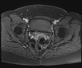 File:Class II Mullerian duct anomaly- unicornuate uterus with rudimentary horn and non-communicating cavity (Radiopaedia 39441-41755 Axial T1 fat sat 96).jpg