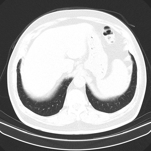 Classic complicated silicosis (Radiopaedia 49720-54961 Axial lung window 53).jpg