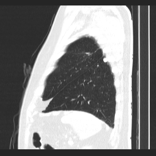 Classic complicated silicosis (Radiopaedia 49720-54961 Sagittal lung window 10).jpg