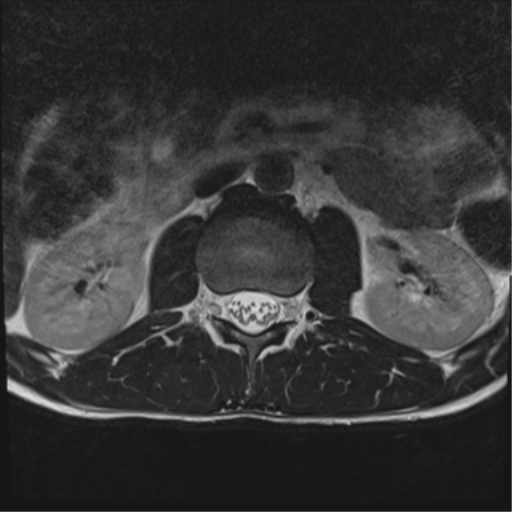File:Clear cell meningoma - lumbar spine (Radiopaedia 60116-67690 Axial T2 35).png
