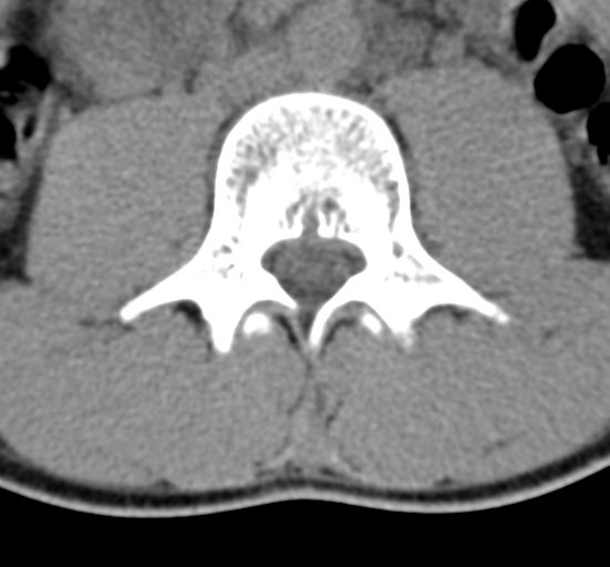 Clear cell meningoma - lumbar spine (Radiopaedia 60116-67691 Axial non-contrast 38).png