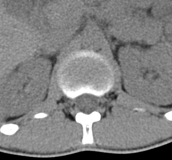 File:Clear cell meningoma - lumbar spine (Radiopaedia 60116-67691 Axial non-contrast 8).png