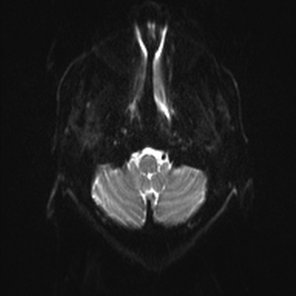 File:Clival meningioma (Radiopaedia 53278-59248 Axial DWI 2).jpg