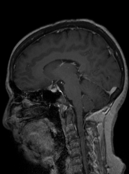 Clival meningioma (Radiopaedia 53278-59248 Sagittal T1 C+ 244).jpg