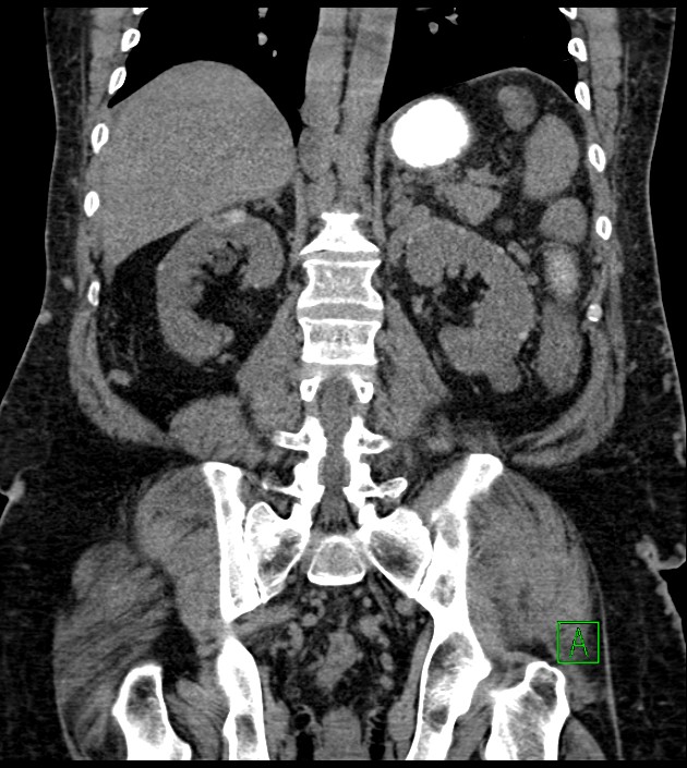 Closed-loop small bowel obstruction-internal hernia (Radiopaedia 78439-91096 Coronal non-contrast 70).jpg
