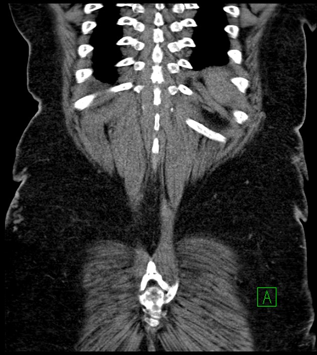 Closed-loop small bowel obstruction-internal hernia (Radiopaedia 78439-91096 Coronal non-contrast 89).jpg