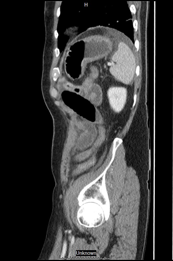Closed loop bowel obstruction and ischemia (Radiopaedia 86959-103180 C 8).jpg