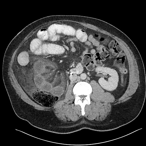 File:Closed loop obstruction - internal hernia into nephrectomy bed (Radiopaedia 59867-67320 A 68).jpg
