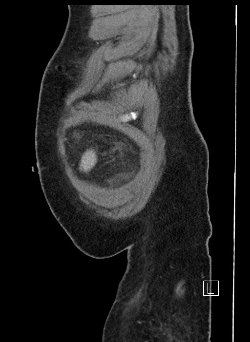Closed loop obstruction - internal hernia into nephrectomy bed (Radiopaedia 59867-67320 C 106).jpg