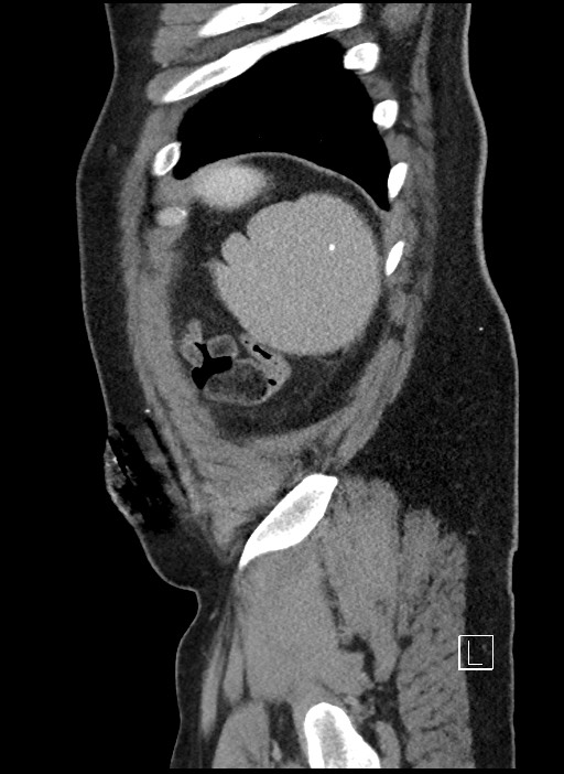 Closed loop obstruction - internal hernia into nephrectomy bed (Radiopaedia 59867-67320 C 2).jpg