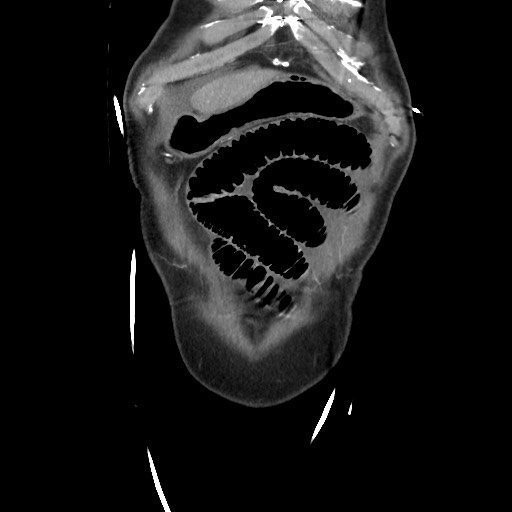 File:Closed loop obstruction due to adhesive band, resulting in small bowel ischemia and resection (Radiopaedia 83835-99023 C 20).jpg