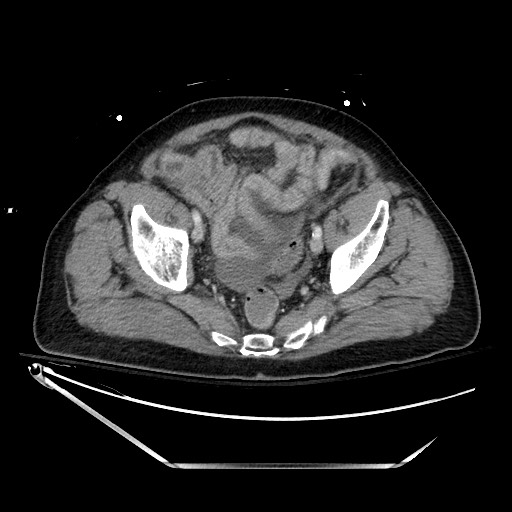 File:Closed loop obstruction due to adhesive band, resulting in small bowel ischemia and resection (Radiopaedia 83835-99023 D 131).jpg