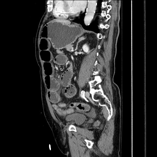 File:Closed loop obstruction due to adhesive band, resulting in small bowel ischemia and resection (Radiopaedia 83835-99023 F 113).jpg