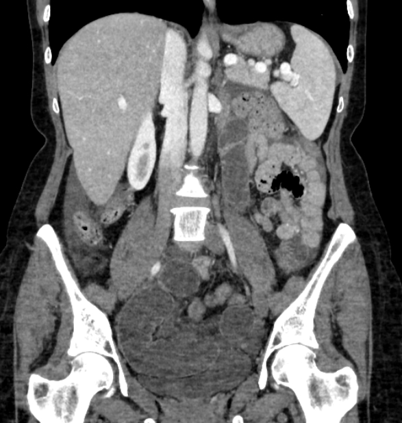 Closed loop small bowel obstruction (Radiopaedia 71211-81508 B 65).jpg