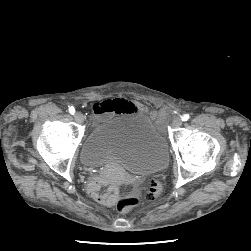 Closed loop small bowel obstruction - adhesions and infarct (Radiopaedia 85125-100678 A 187).jpg