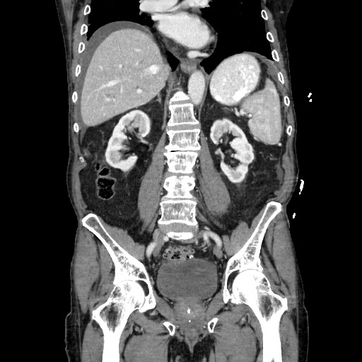 Closed loop small bowel obstruction - adhesive disease and hemorrhagic ischemia (Radiopaedia 86831-102990 B 80).jpg