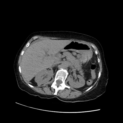 Closed loop small bowel obstruction due to adhesive band, with intramural hemorrhage and ischemia (Radiopaedia 83831-99017 Axial non-contrast 54).jpg