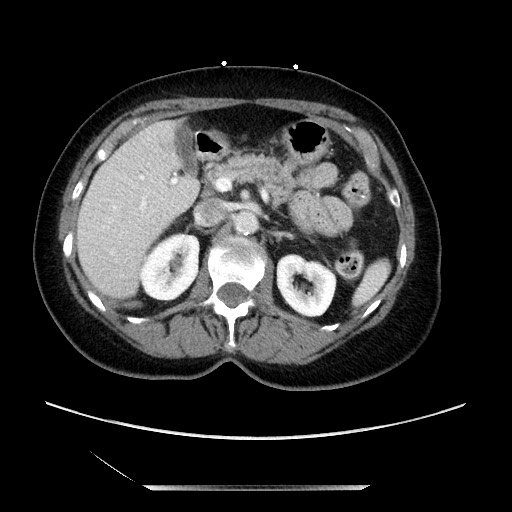 File:Closed loop small bowel obstruction due to adhesive bands - early and late images (Radiopaedia 83830-99014 A 43).jpg