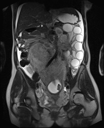 File:Closed loop small bowel obstruction in pregnancy (MRI) (Radiopaedia 87637-104031 Coronal T2 32).jpg